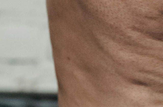 셀룰라이트 — 피부 표면의 울퉁불퉁한 오렌지필 질감