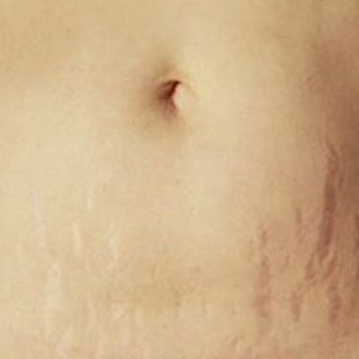 복부 튼살 — 임신 후 튼살